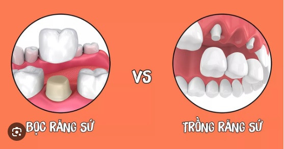 Trồng răng sứ hay bọc răng sứ: phương pháp nào là tốt hơn?